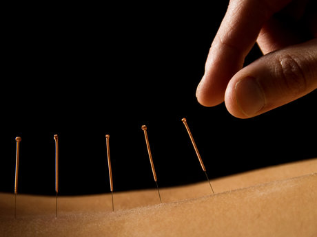 Acupuncture