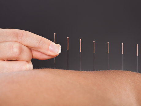 Acupuncture and Chinese Herbs