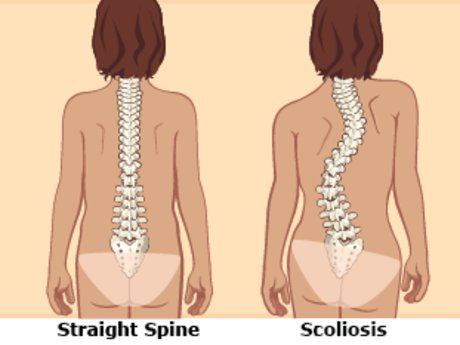 Ask someone with Scoliosis